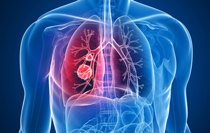 Nuevas guías clínicas GOECP/SEOR de radioterapia en cáncer de pulmón, timoma y mesotelioma