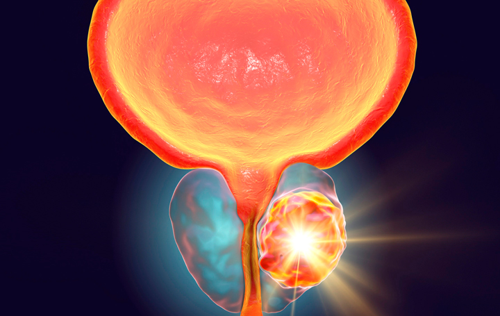 URONCOR estudia si seis meses de terapia hormonal combinada con radioterapia de rescate puede igualar en resultados al estándar de dos años en cáncer de próstata.